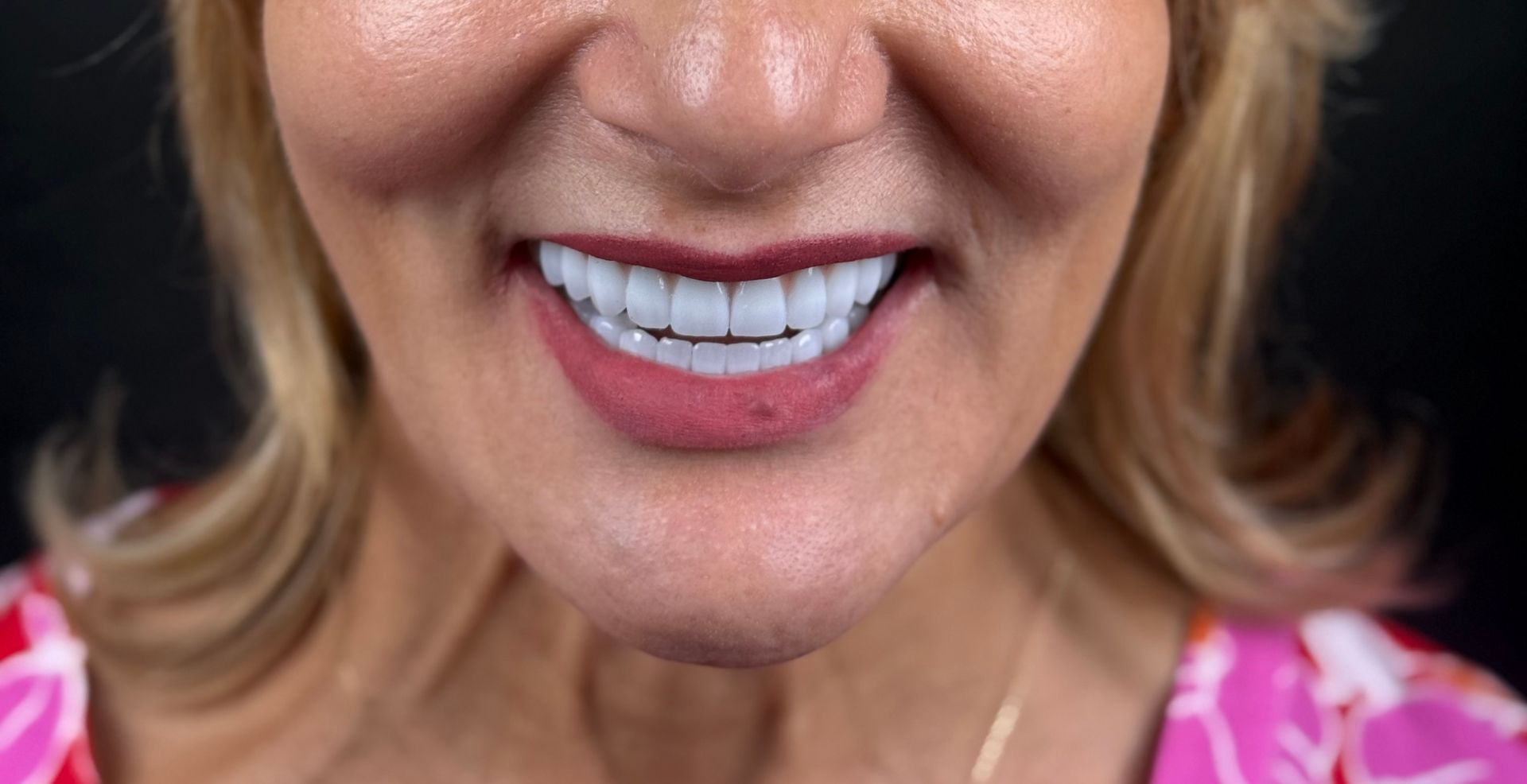Caz Reabilitare completă, caz multidisciplinar la Anghele Dental Iași, rezultat după tratament