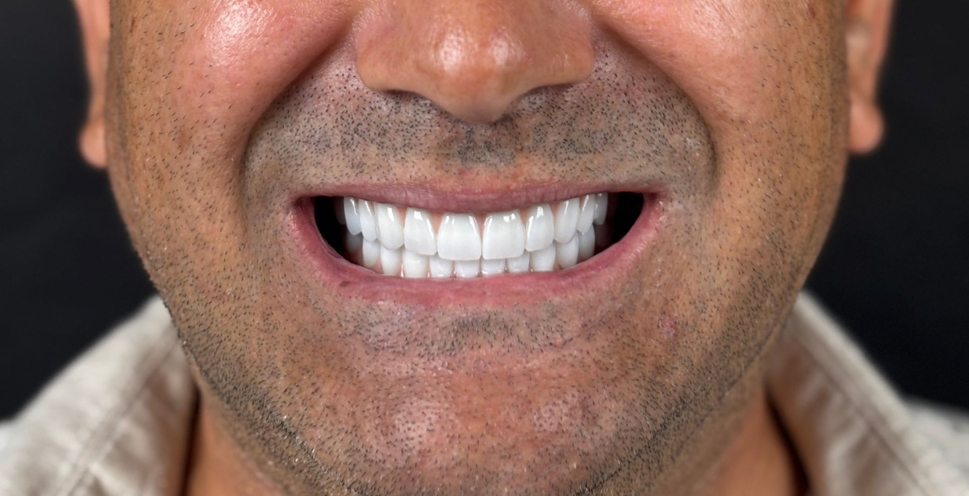 Caz Rezultat tratament dental Anghele Dental Iași la Anghele Dental Iași, rezultat după tratament