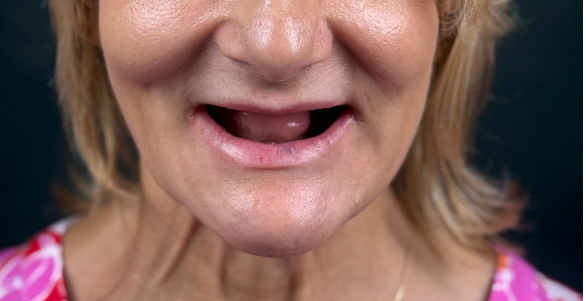 Caz Reabilitare completă, caz multidisciplinar la Anghele Dental Iași, fotografie clinică înainte