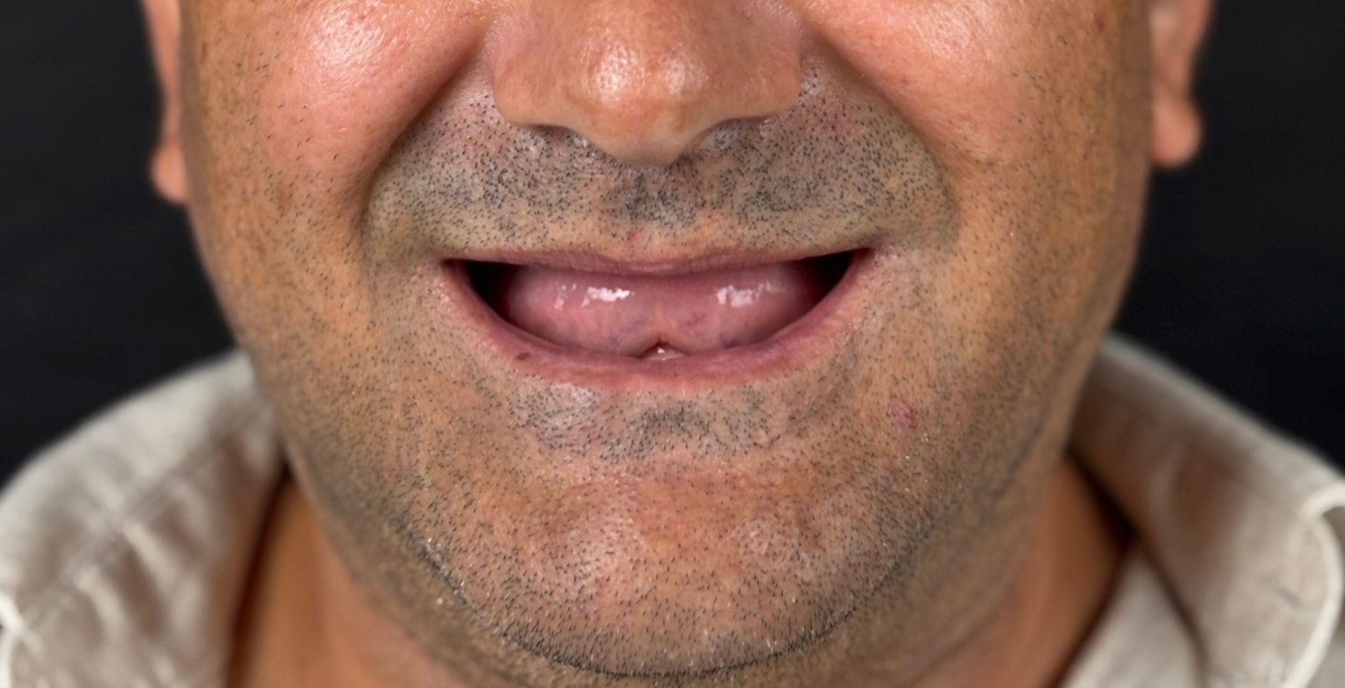 Caz Rezultat tratament dental Anghele Dental Iași la Anghele Dental Iași, fotografie clinică înainte
